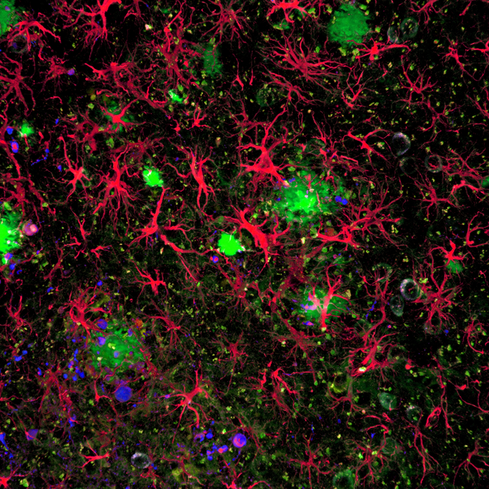 Confocal image depicting activated astrocytes surrounding amyloid plaques (protein deposits in the extracellular space in the brain of Alzheimer's disease patients), shown here in the cortex of an animal mouse model of Alzheimer's disease. Astrocytes are pseudocolored in red and amyloid plaques are shown in green.